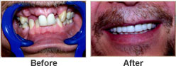 Perfect smile - Hankinson Dental - Before After