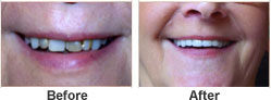 Cosmetic - Before After - Hankinson Dental - Hanksinon North Dakota