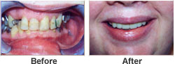 Perfect smile - Hankinson Dental - Before After Hanksinon North Dakota