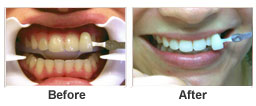 Perfect smile - Hankinson Dental - Before After